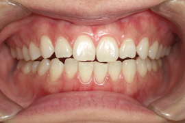 歯肉（歯ぐき）のホワイトニング（ピーリング）について